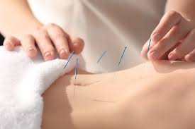 acupuncture in karaikudi acupuncture in karaikudi
